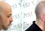 How does scalp micropigmentation work step by step?