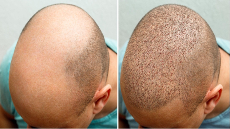 Factors Affecting Hair Transplant Cost